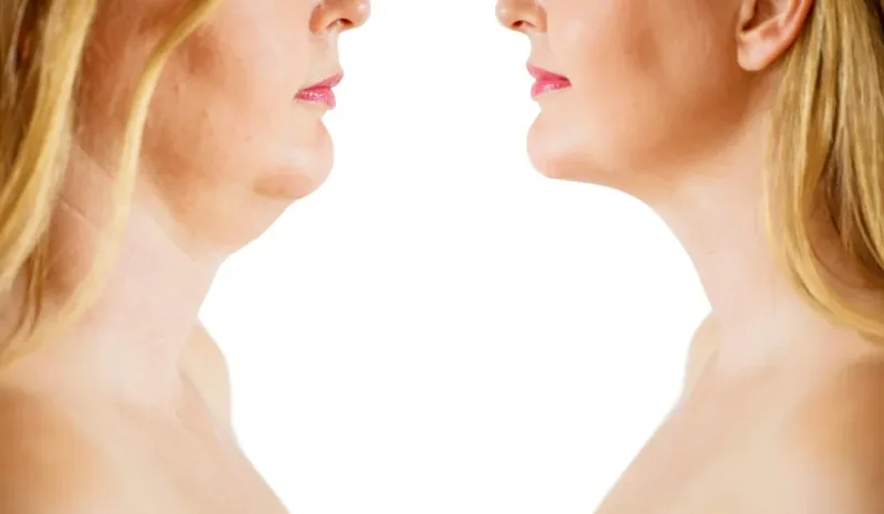 Double chin removal treatments in Torrance, Redondo Beach, and Palos Verdes at Skin Works Medical Spa for a sculpted, defined, and more youthful jawline.