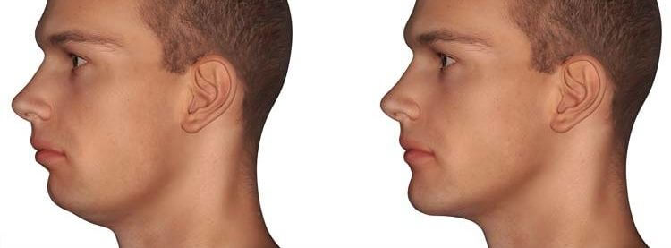 Skin Works Medical Spa is Number one provider of Jawline design and Chin Treatments for Men