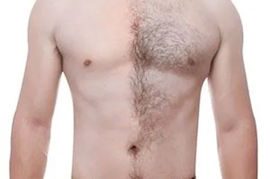 laser hair removal for men and male hair removal in torrance