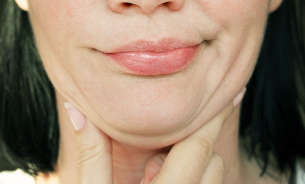 Double chin fat and kybella