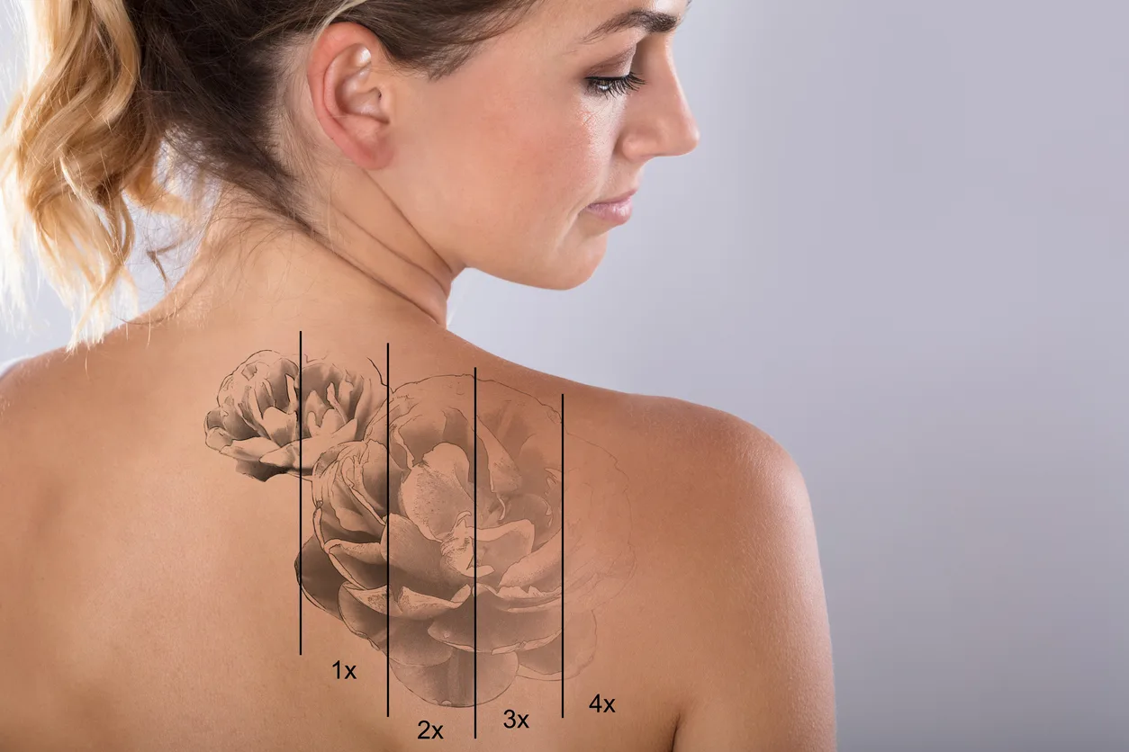 laser Tattoo removal near torrance california
