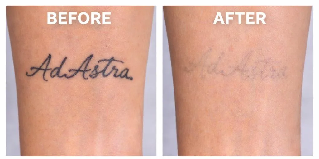 PicoSure laser tattoo removal before and after – small script wrist tattoo fading after treatment
