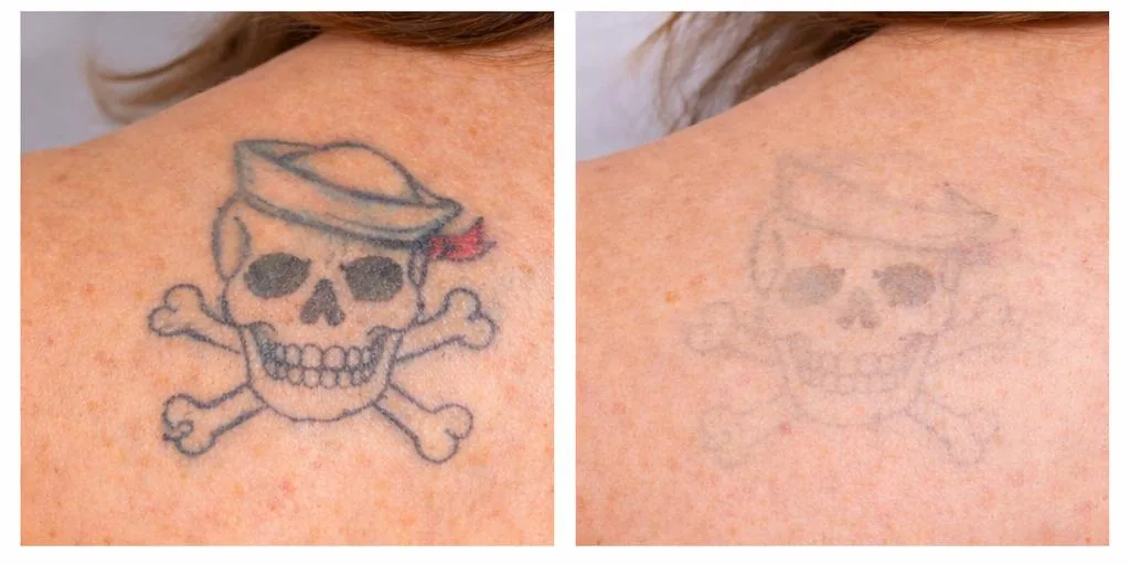 PicoSure laser tattoo removal before and after – small skull tattoo on shoulder fading after treatment