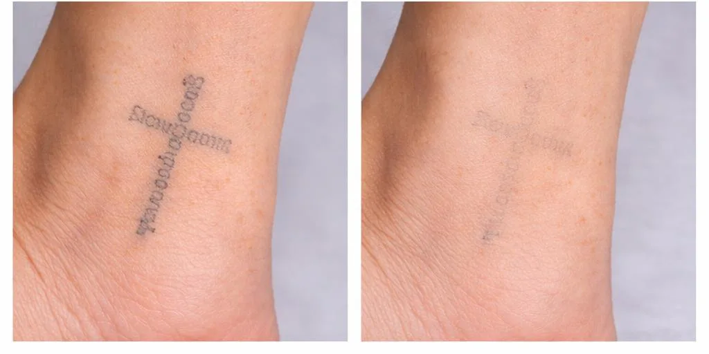 PicoSure laser tattoo removal before and after – small cross tattoo on ankle fading after treatment