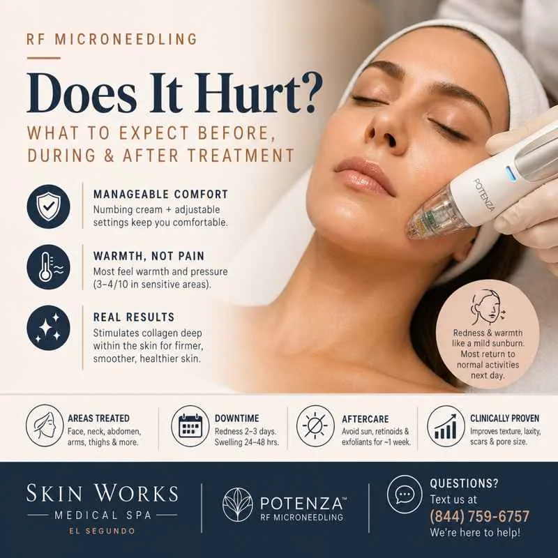 RF microneedling treatment on female face using Potenza device at medical spa, showing skin rejuvenation procedure with minimal discomfort