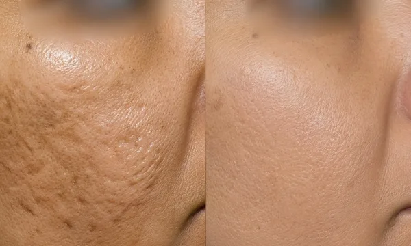 Acne scar before and after treatment