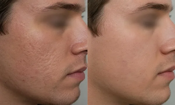 Acne scar before and after result