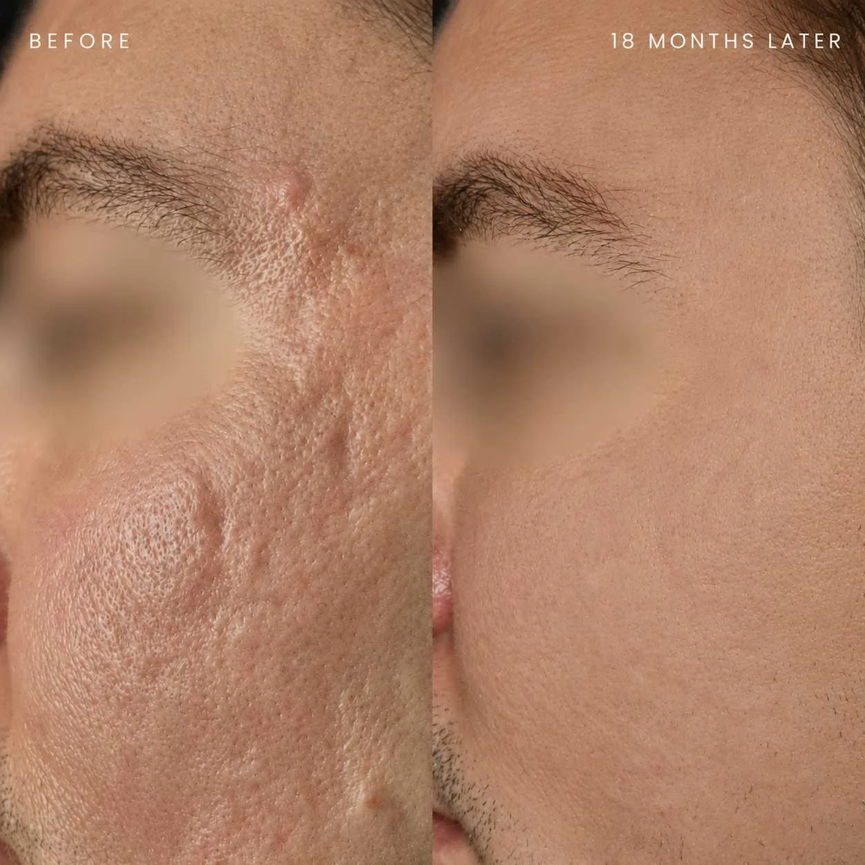Acne scar before and after