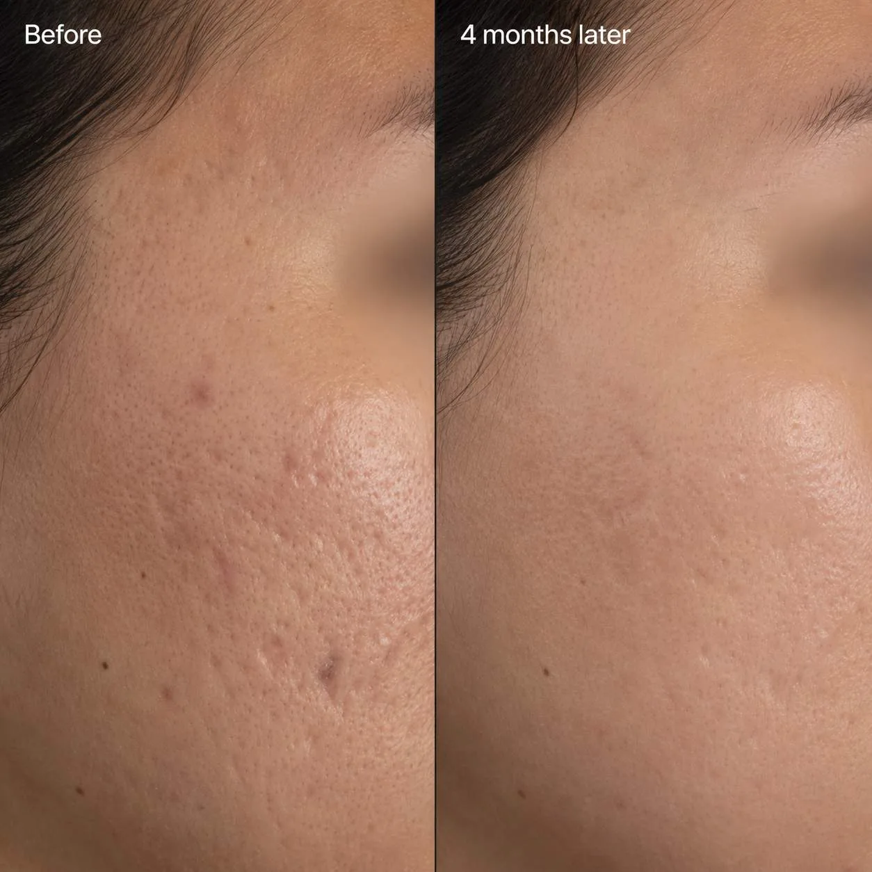 Acne scar before and after