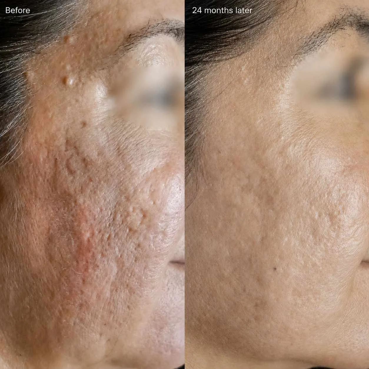 Acne scar before and after