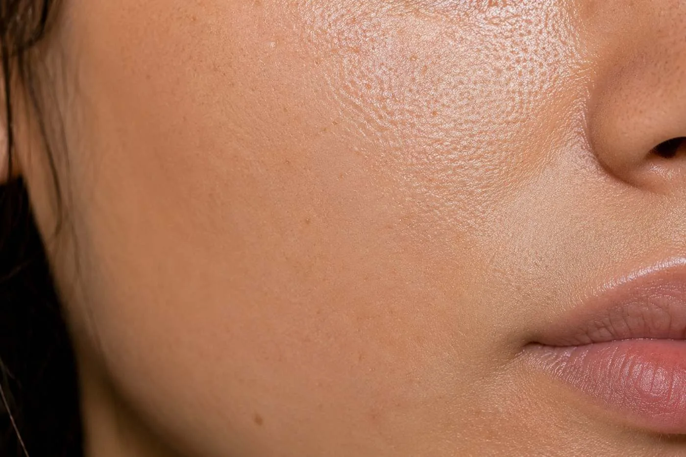 Skin texture after acne scar treatment