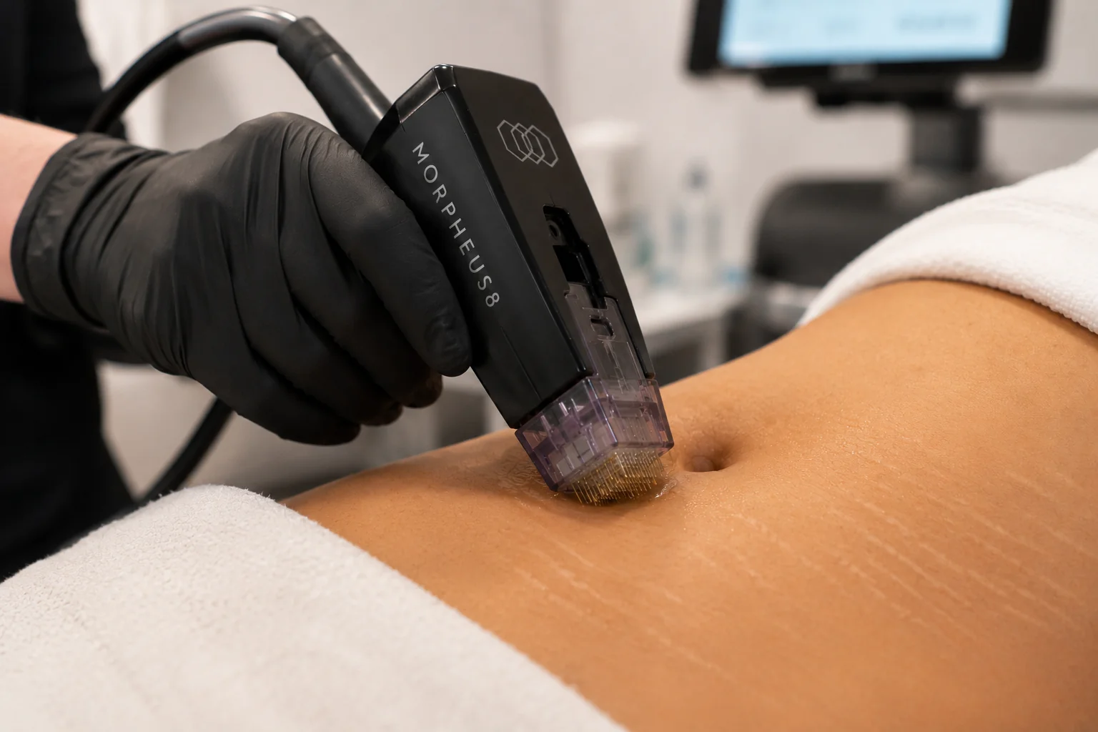 RF microneedling stretch mark treatment at Skin Works Medical Spa Torrance