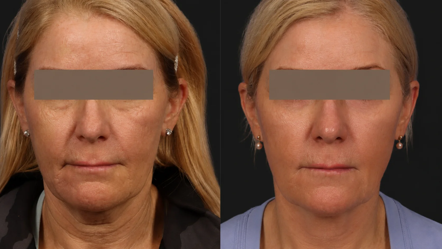 Morpheus8 before and after full face