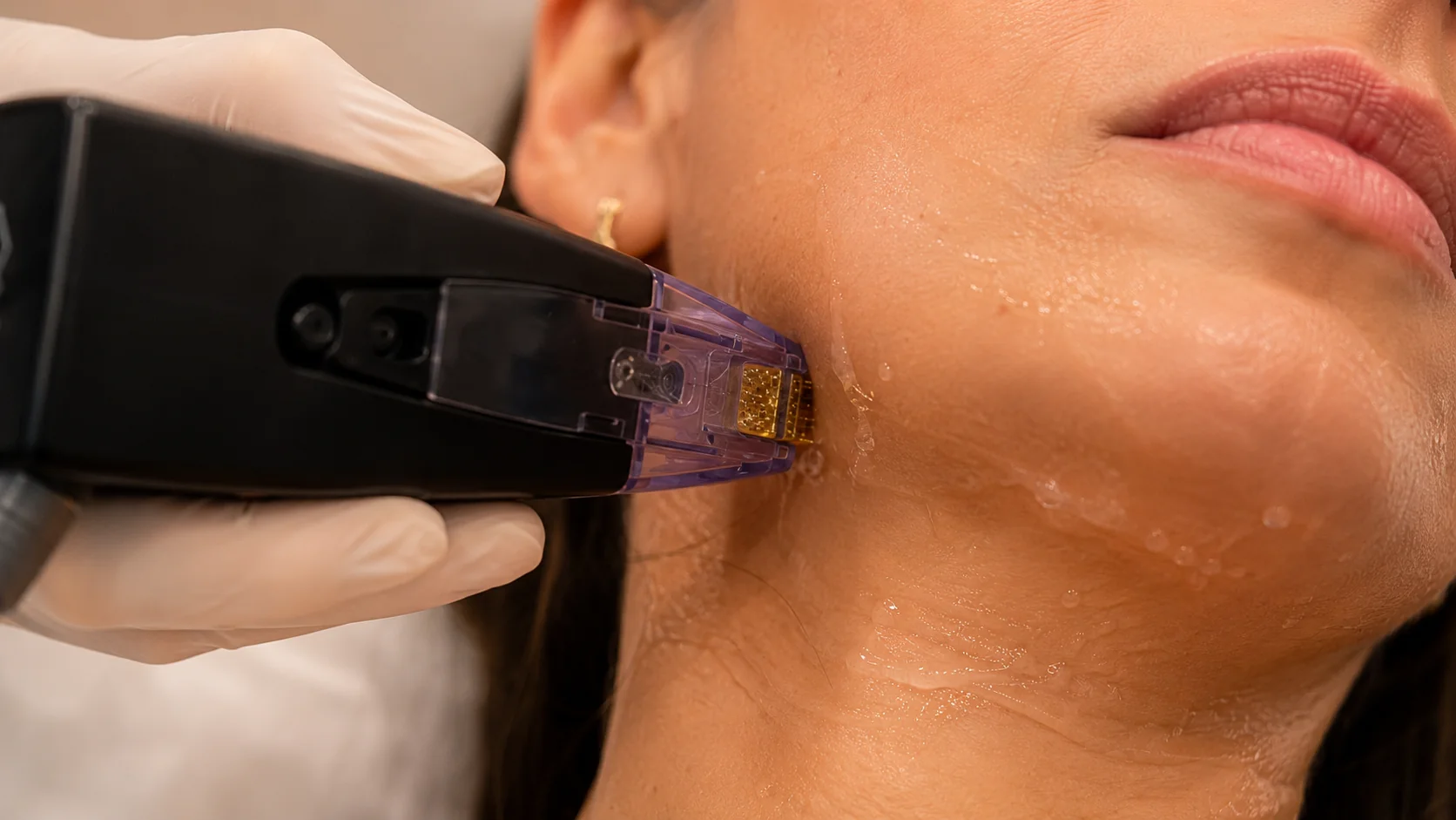 Morpheus8 device on jawline at Skin Works Medical Spa Torrance