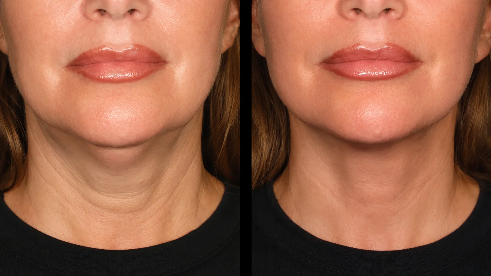 Before and after Ultherapy neck