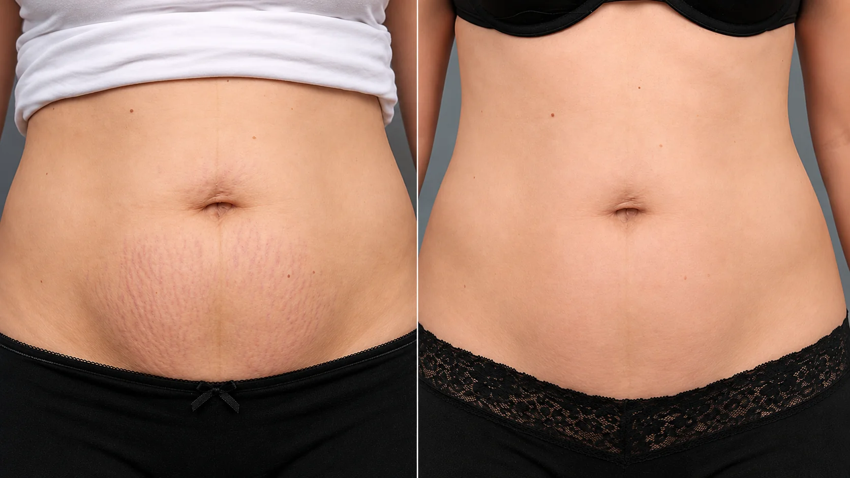 Before and after mature white stretch marks abdomen