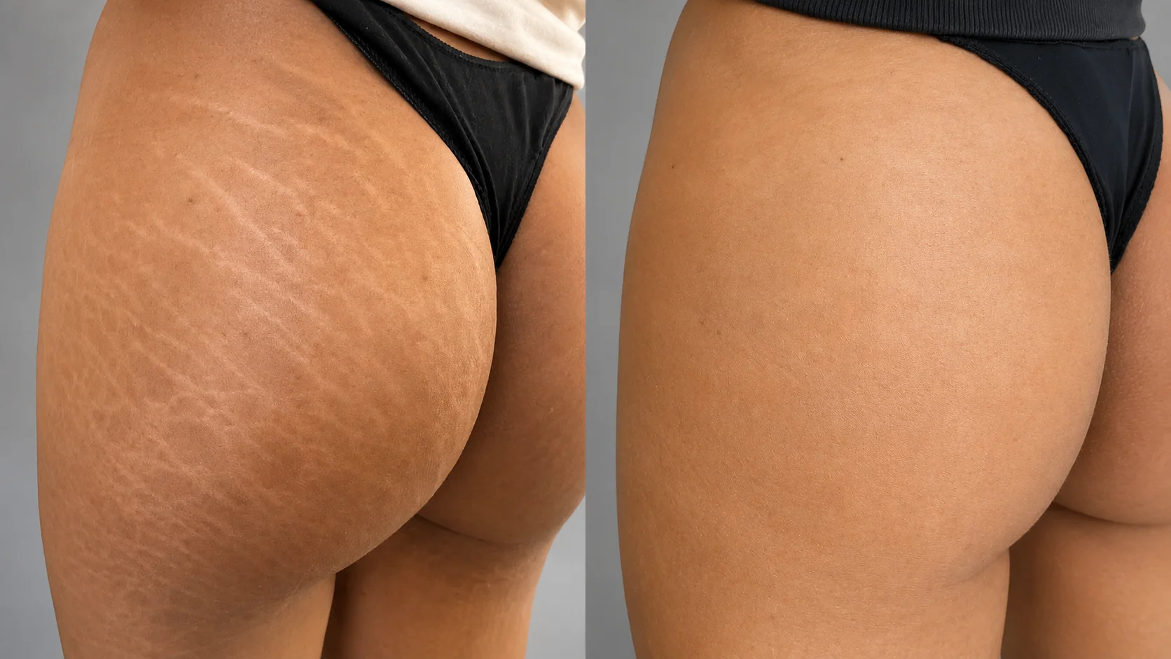 Before and after glutes stretch marks
