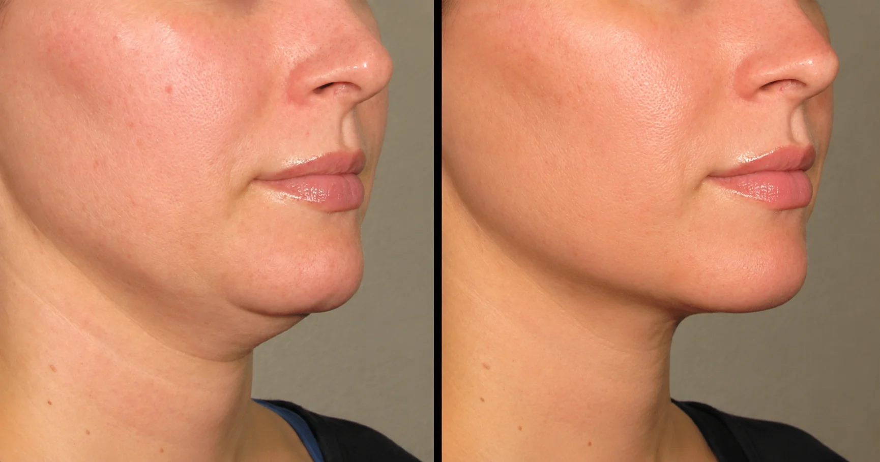 Before and after Ultherapy overall