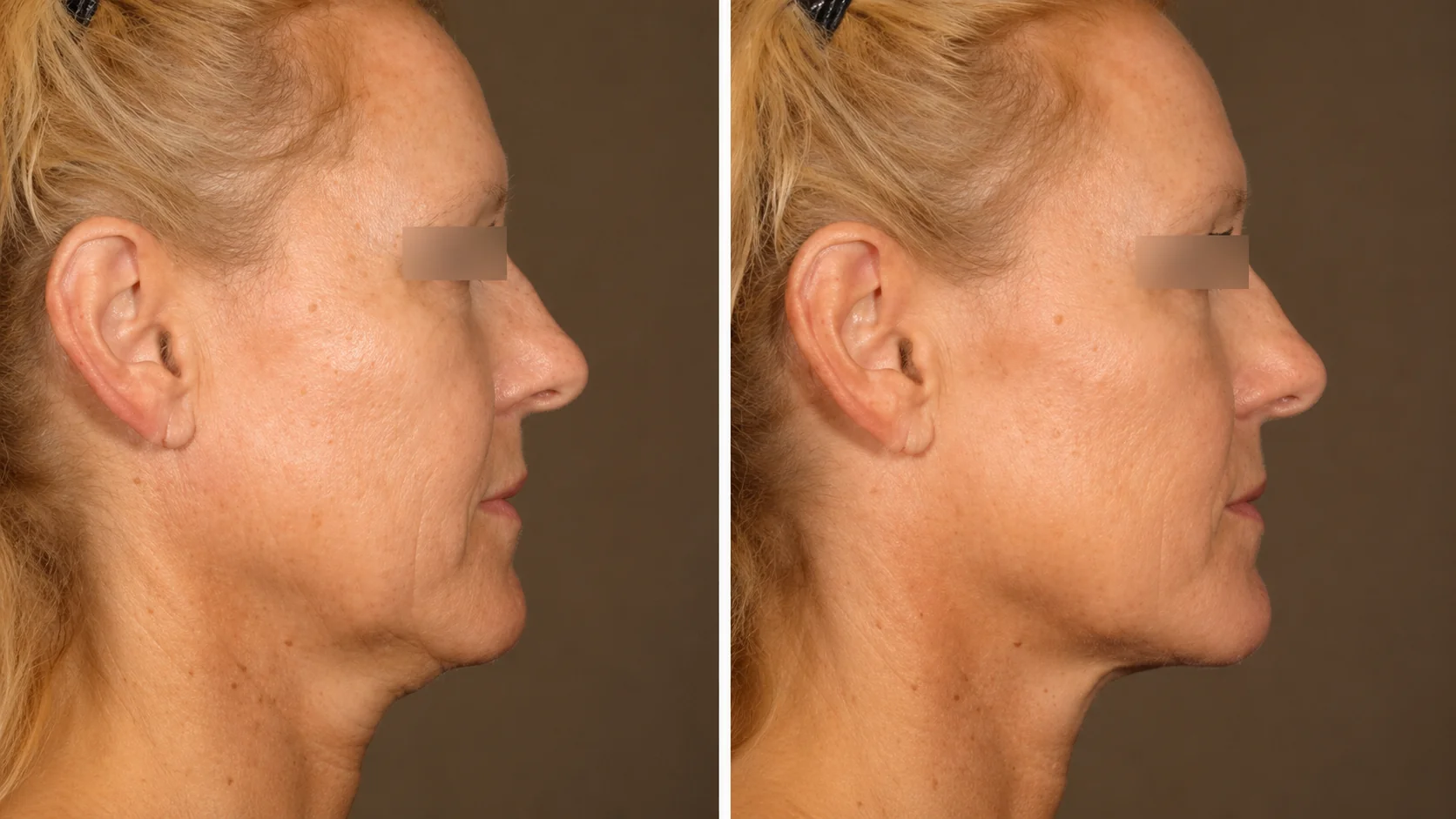 Before and after Ultherapy full face
