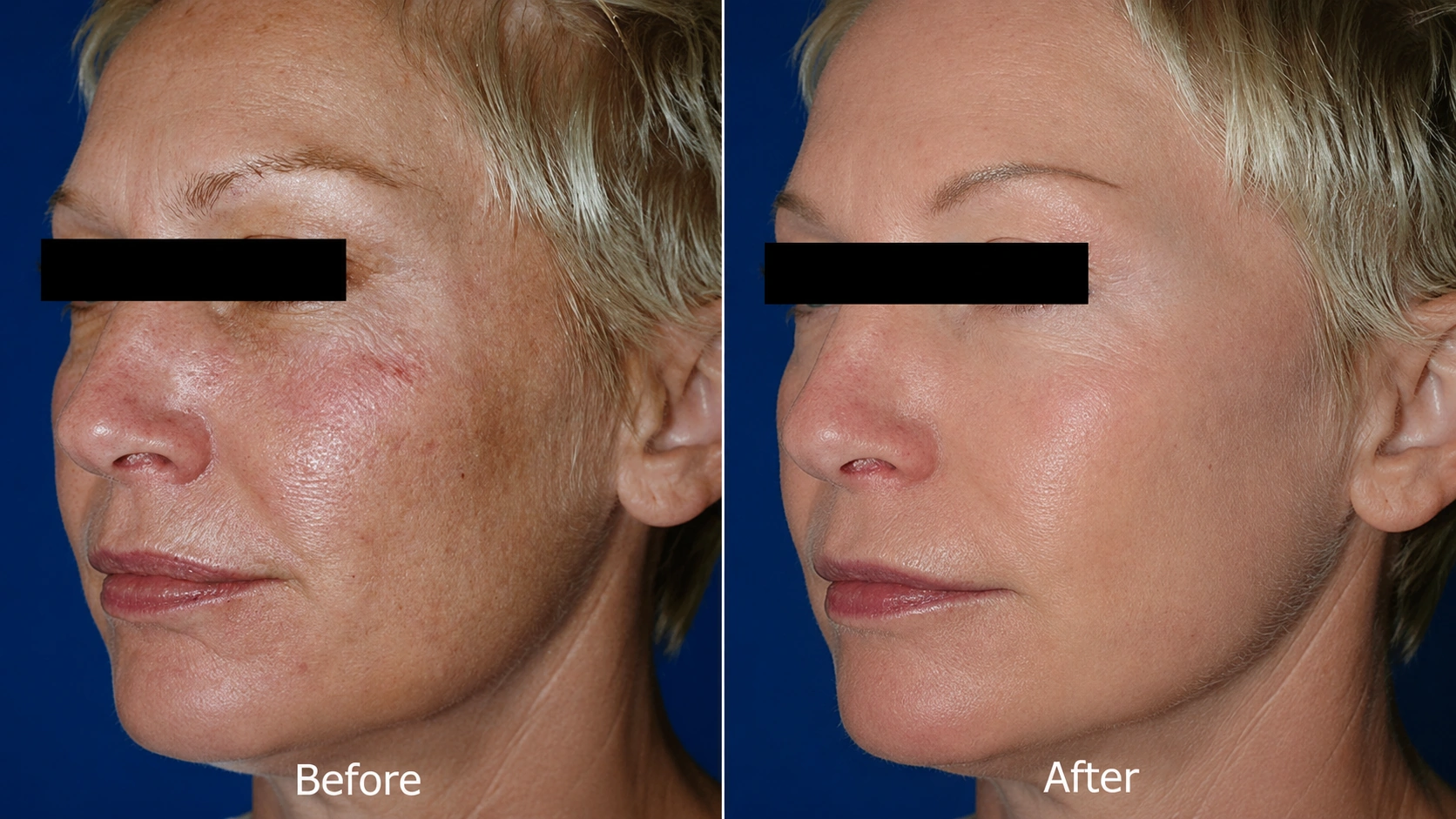 Before and after 1 CO2 laser session plus a 4-session Erbium series
