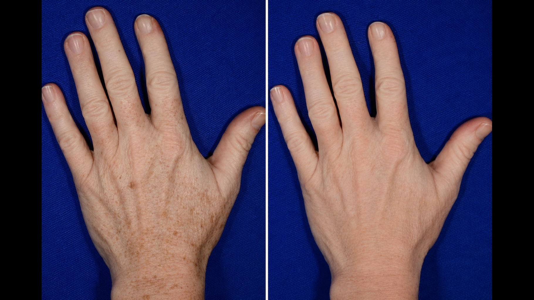 Before and after IPL photofacial series for hands