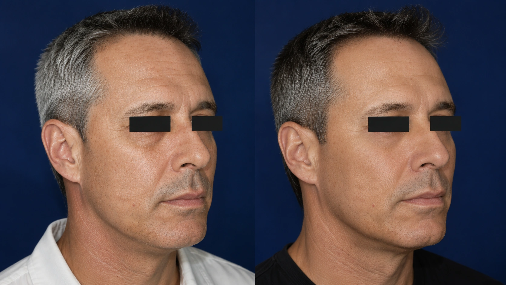 Clinical before and after portrait after fractional CO2 laser resurfacing