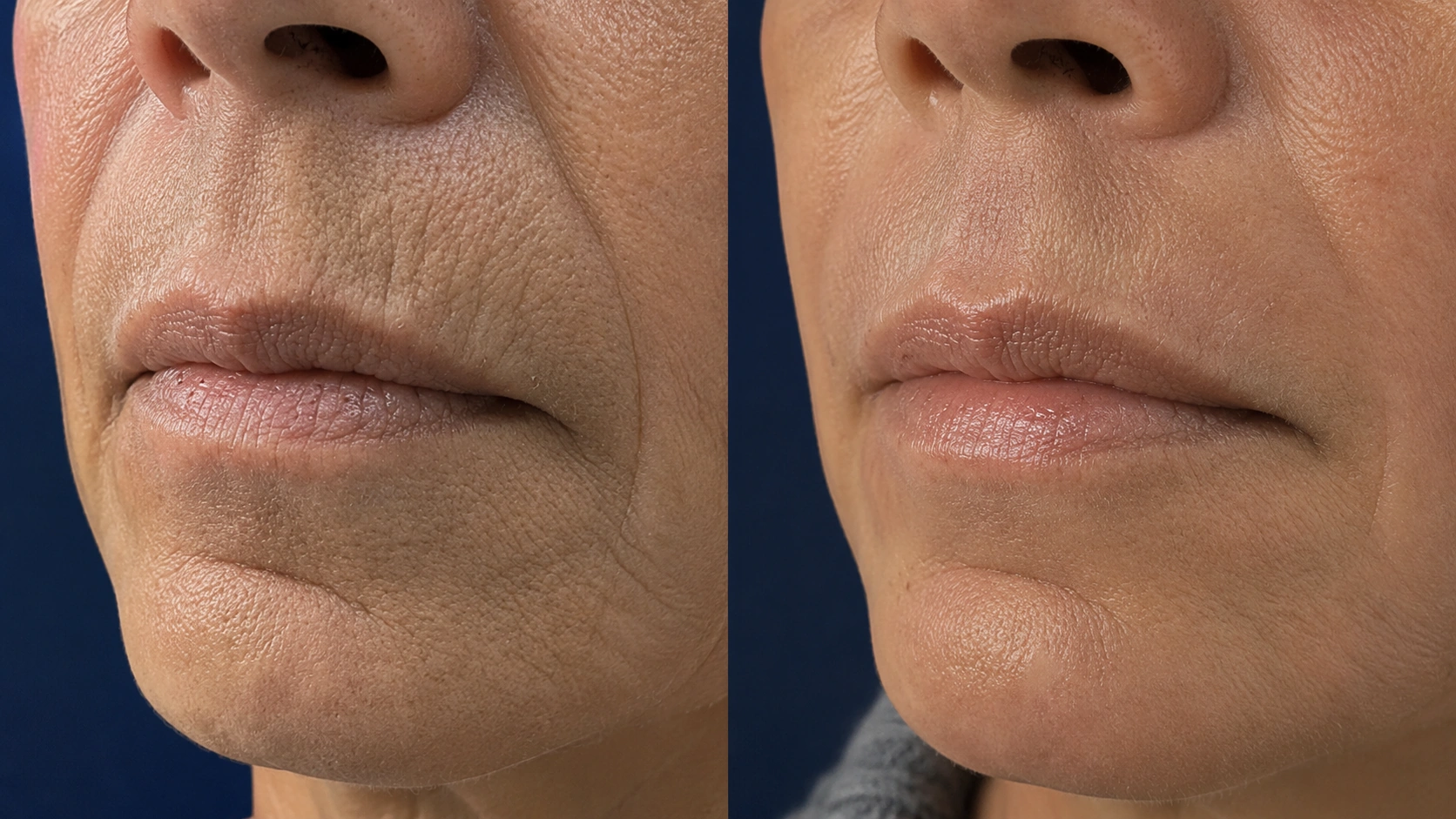 Before and after fractional CO2 laser resurfacing, close-up split screen