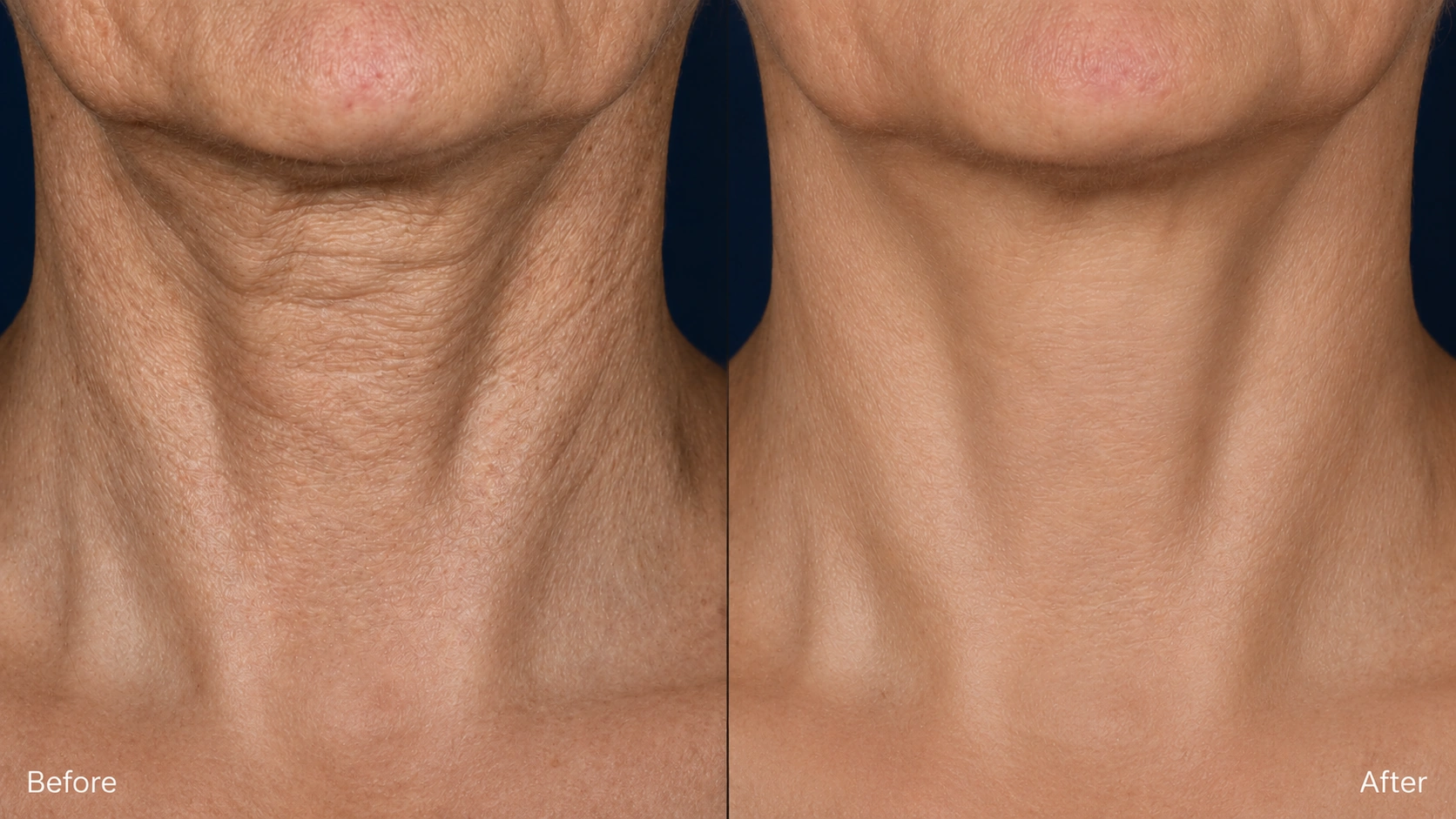 Neck before and after one Ultherapy treatment plus 4 Erbium laser sessions