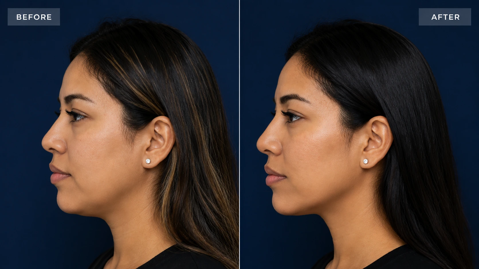 Before and after smile line filler