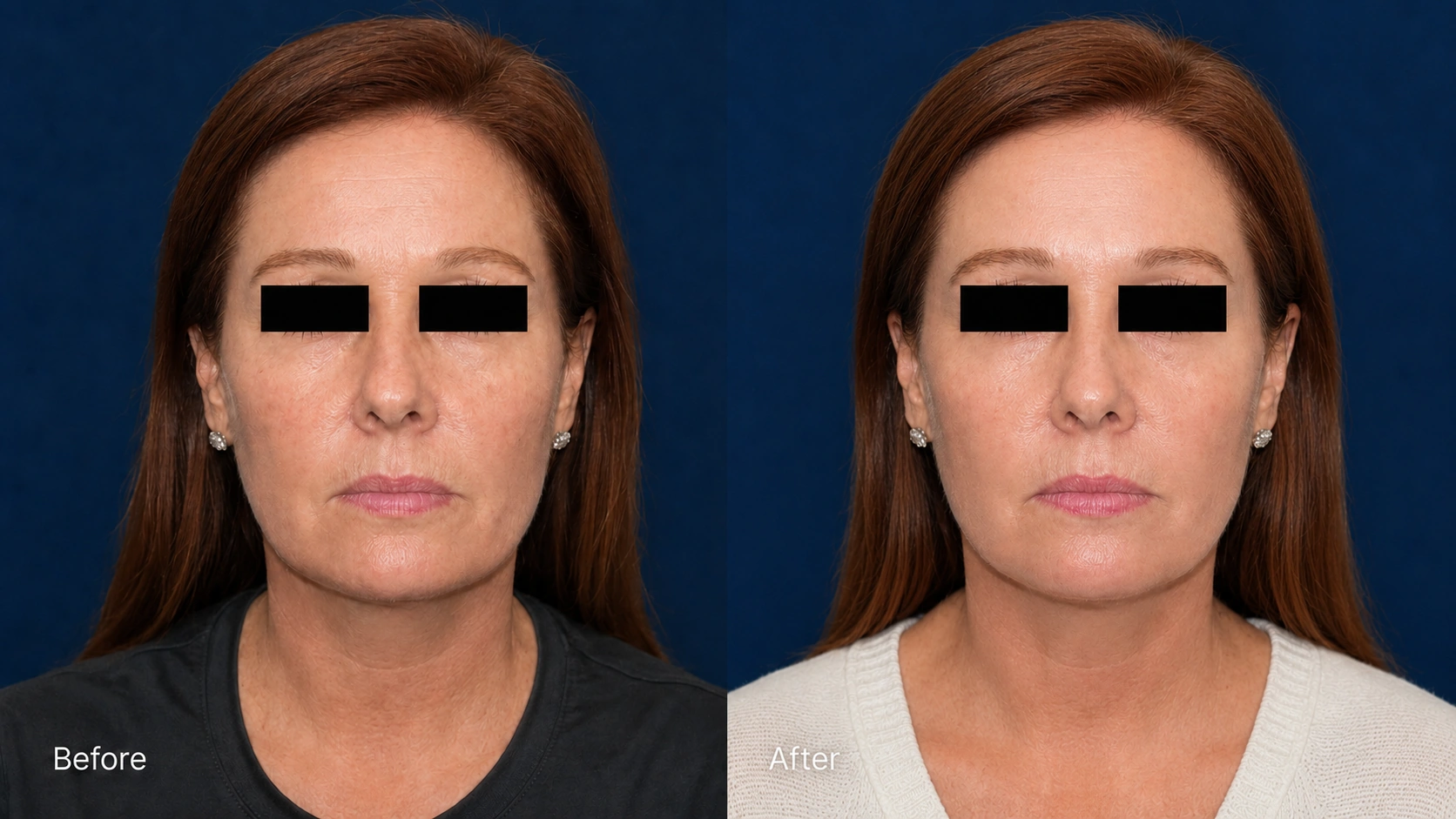 Clinical before and after portrait following Erbium laser treatment