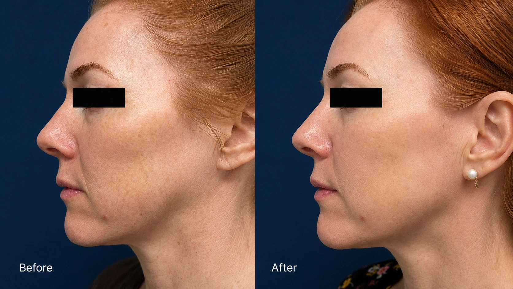 Before and after 1 CO2 laser session plus 2 Erbium laser sessions