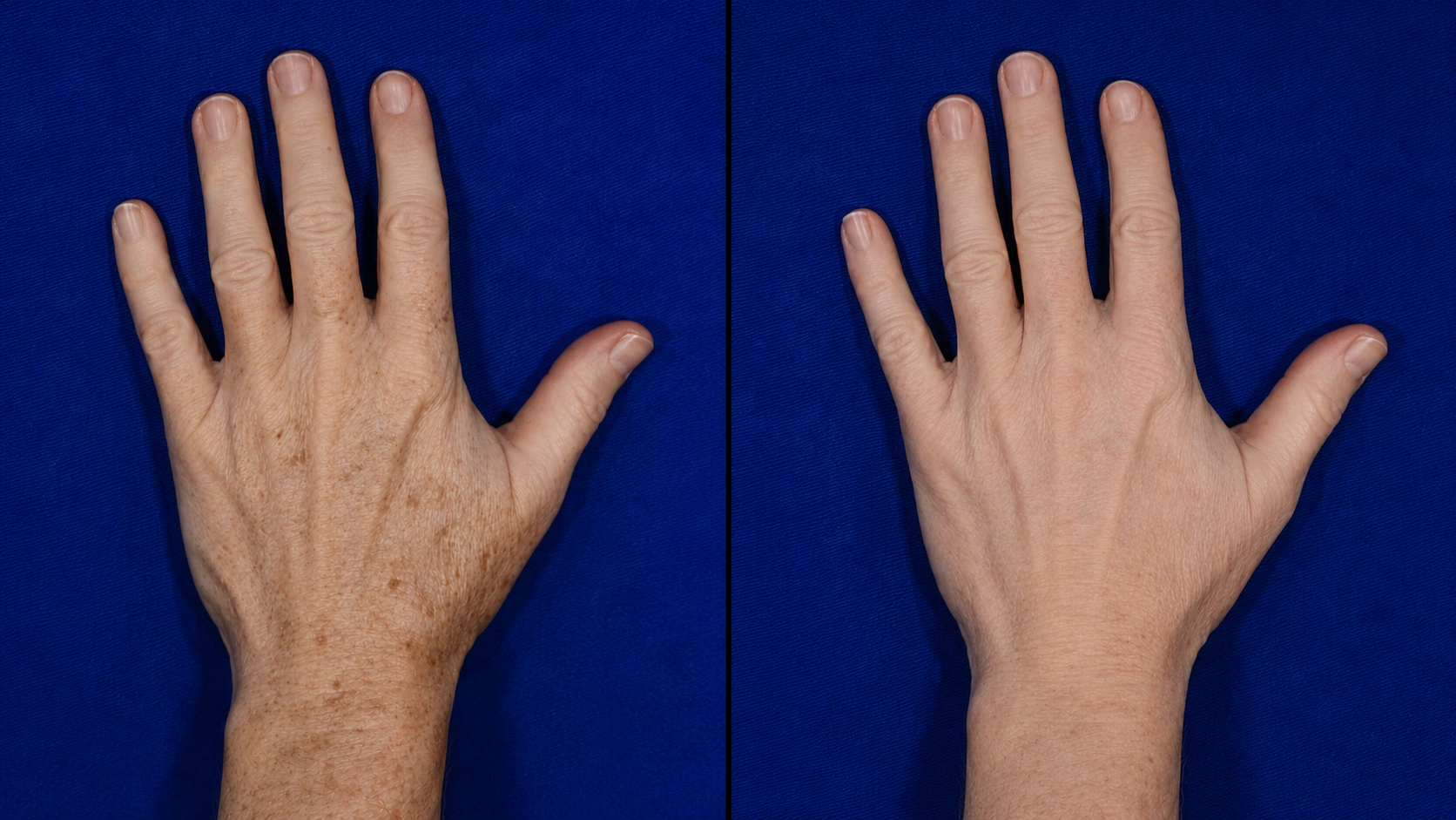 Before and after Erbium laser hand resurfacing