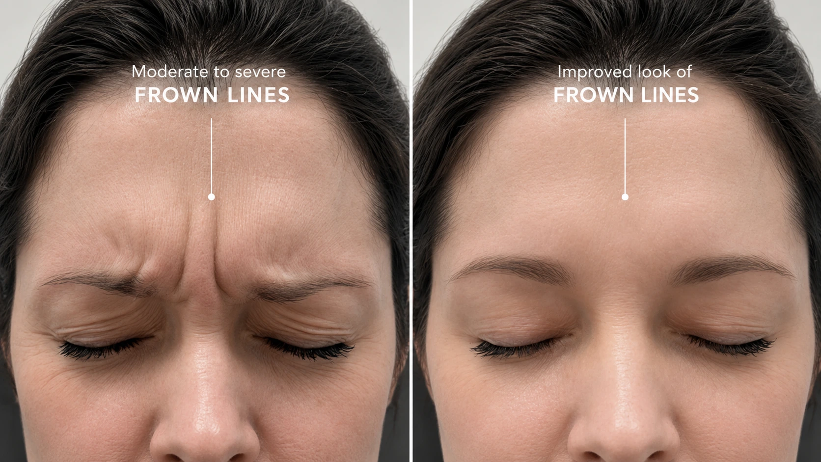 Additional frown line reduction case before and after Botox treatment