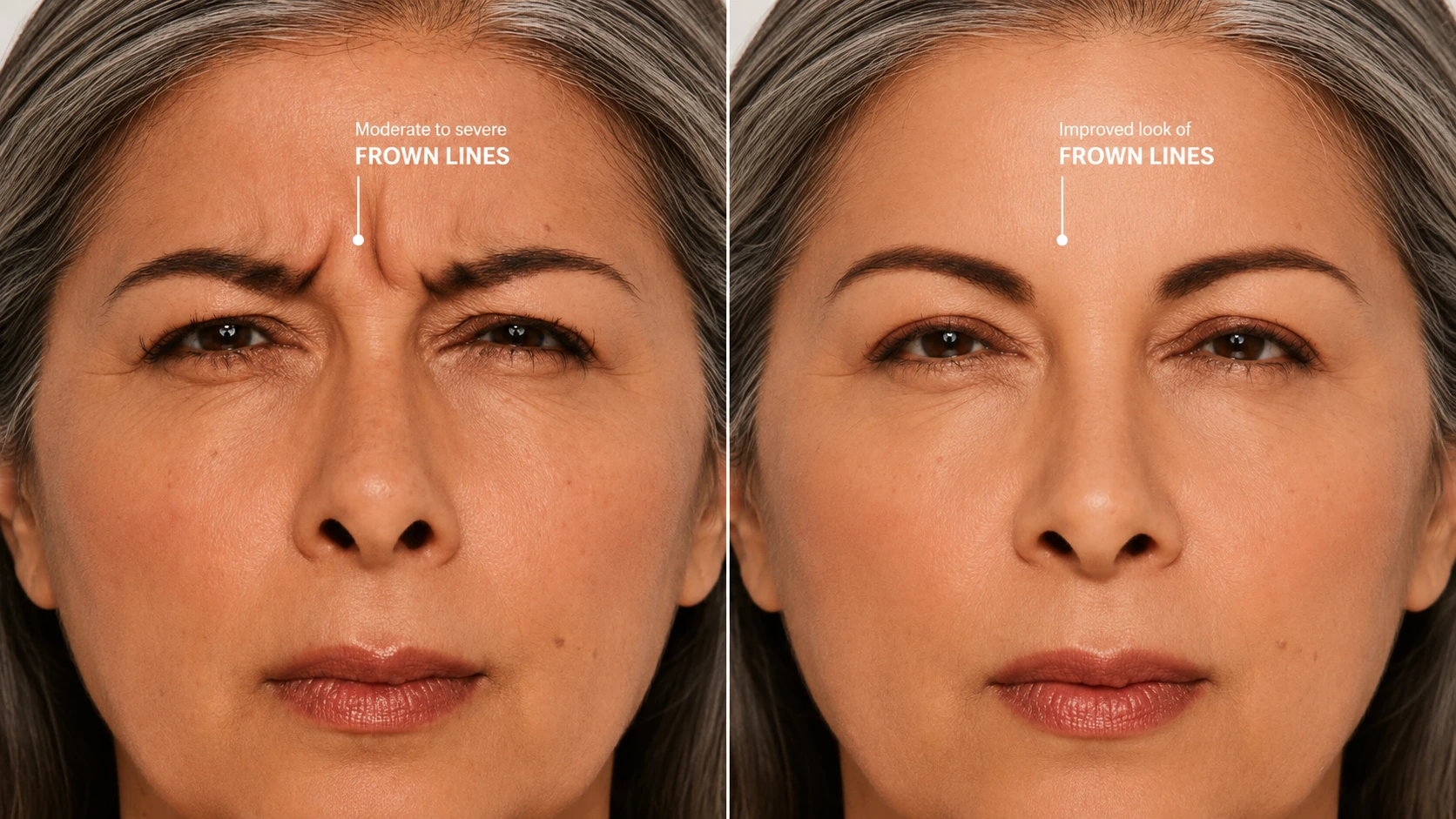 Frown line (glabella) reduction before and after Botox