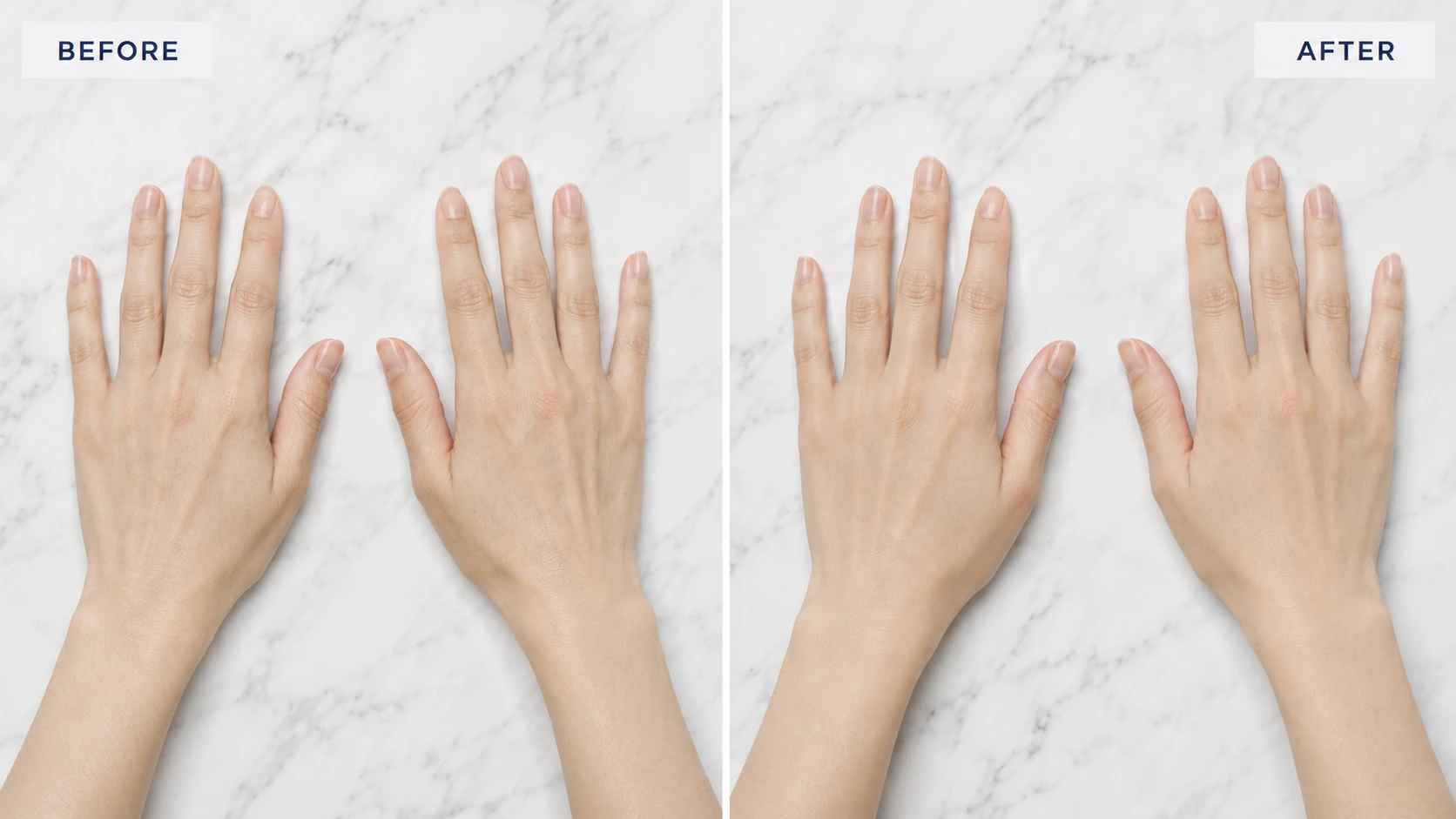 Before and after hand filler