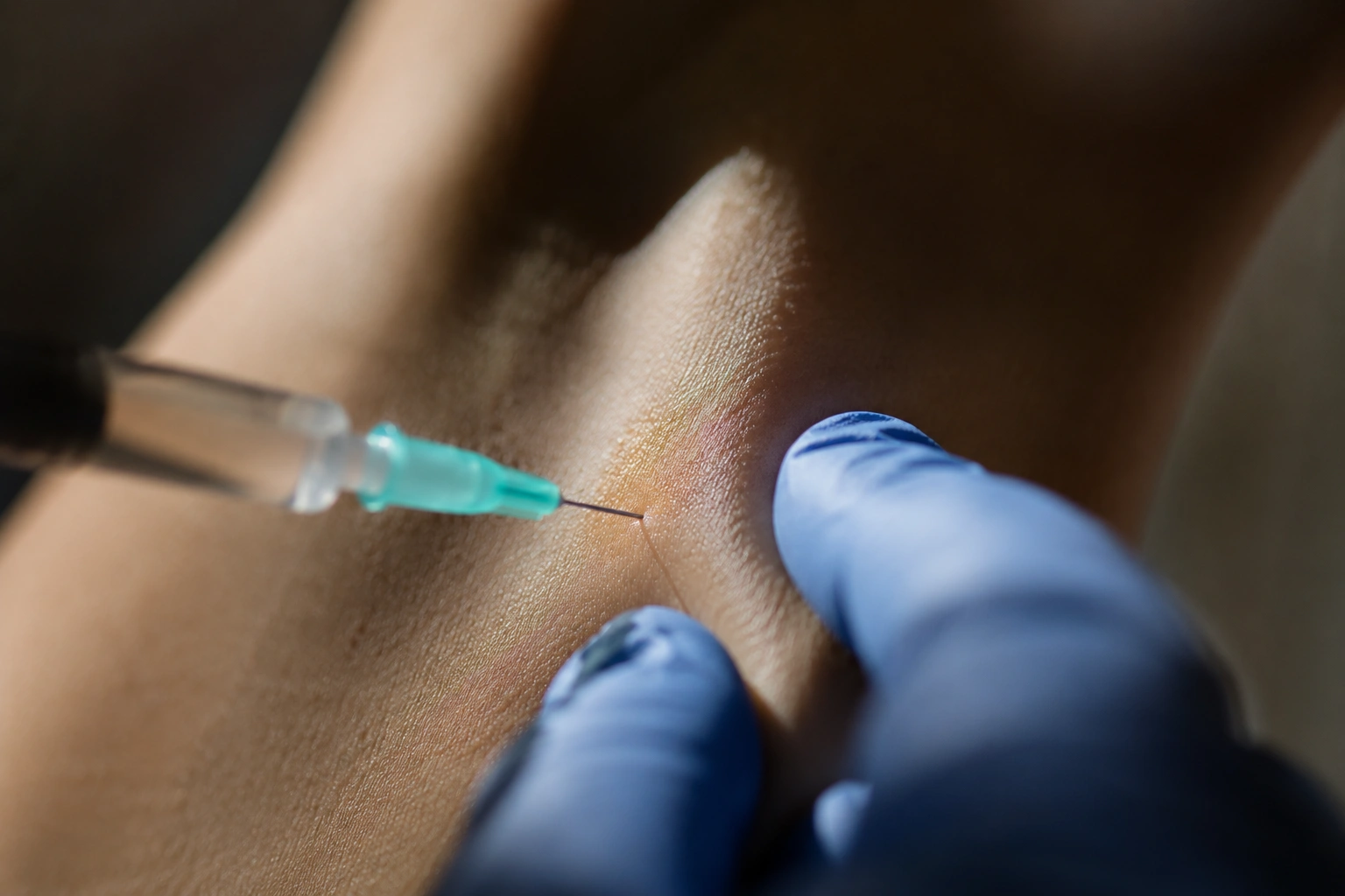 Botox injection for hyperhidrosis at Skin Works Medical Spa