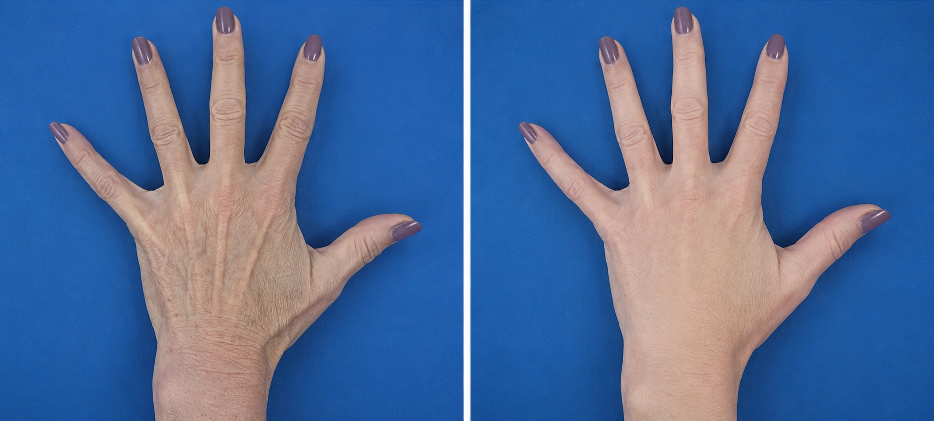 Before and after RADIESSE for hands