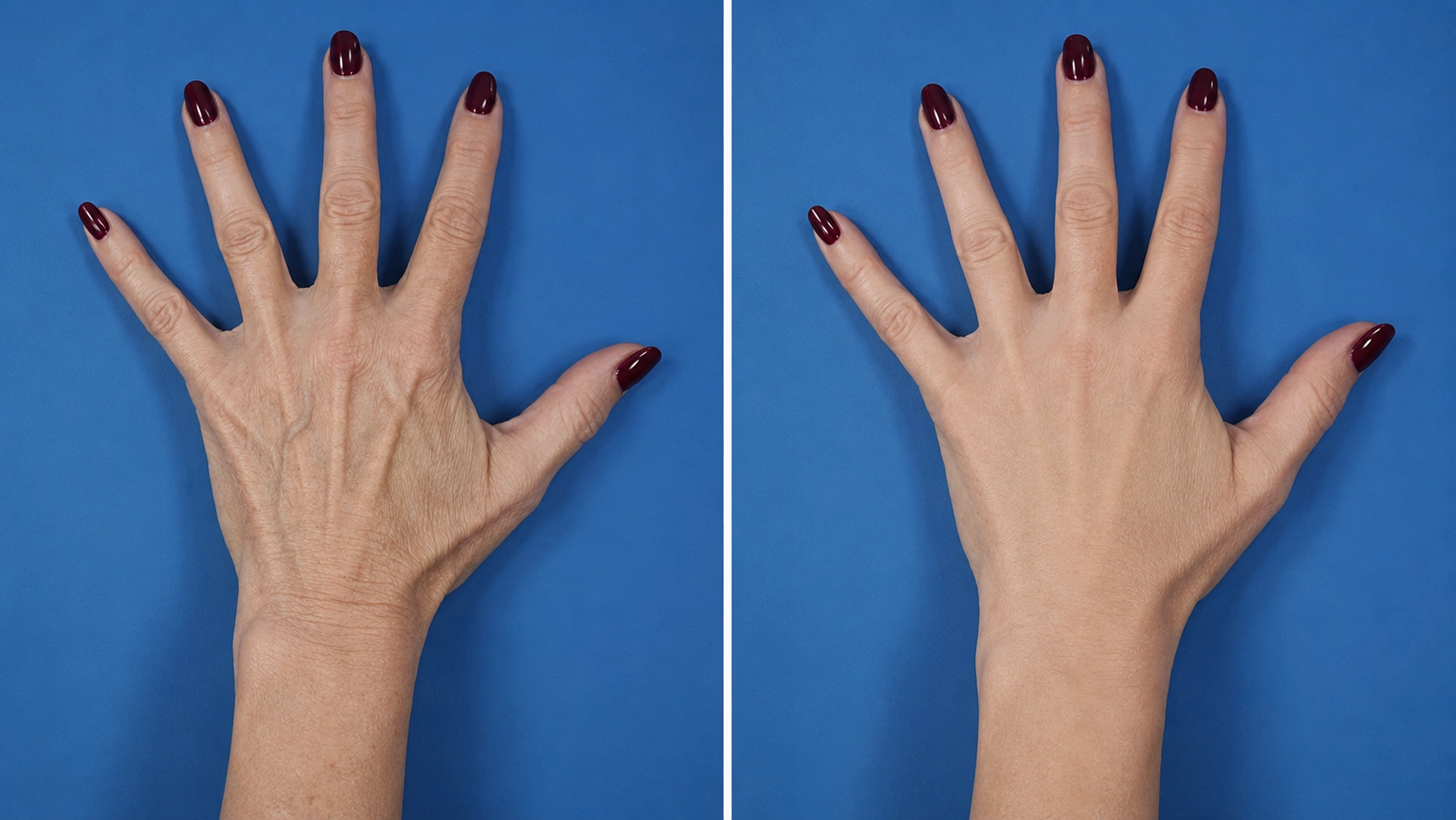 Before and after RADIESSE hand volume restoration