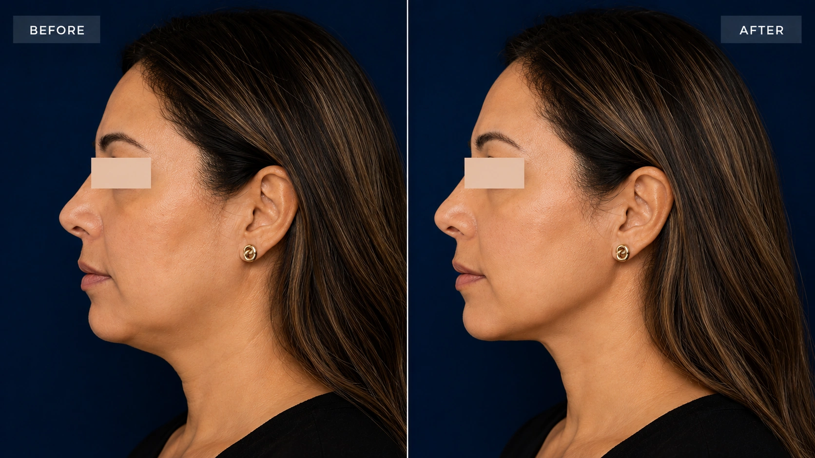 Before and after jawline filler definition