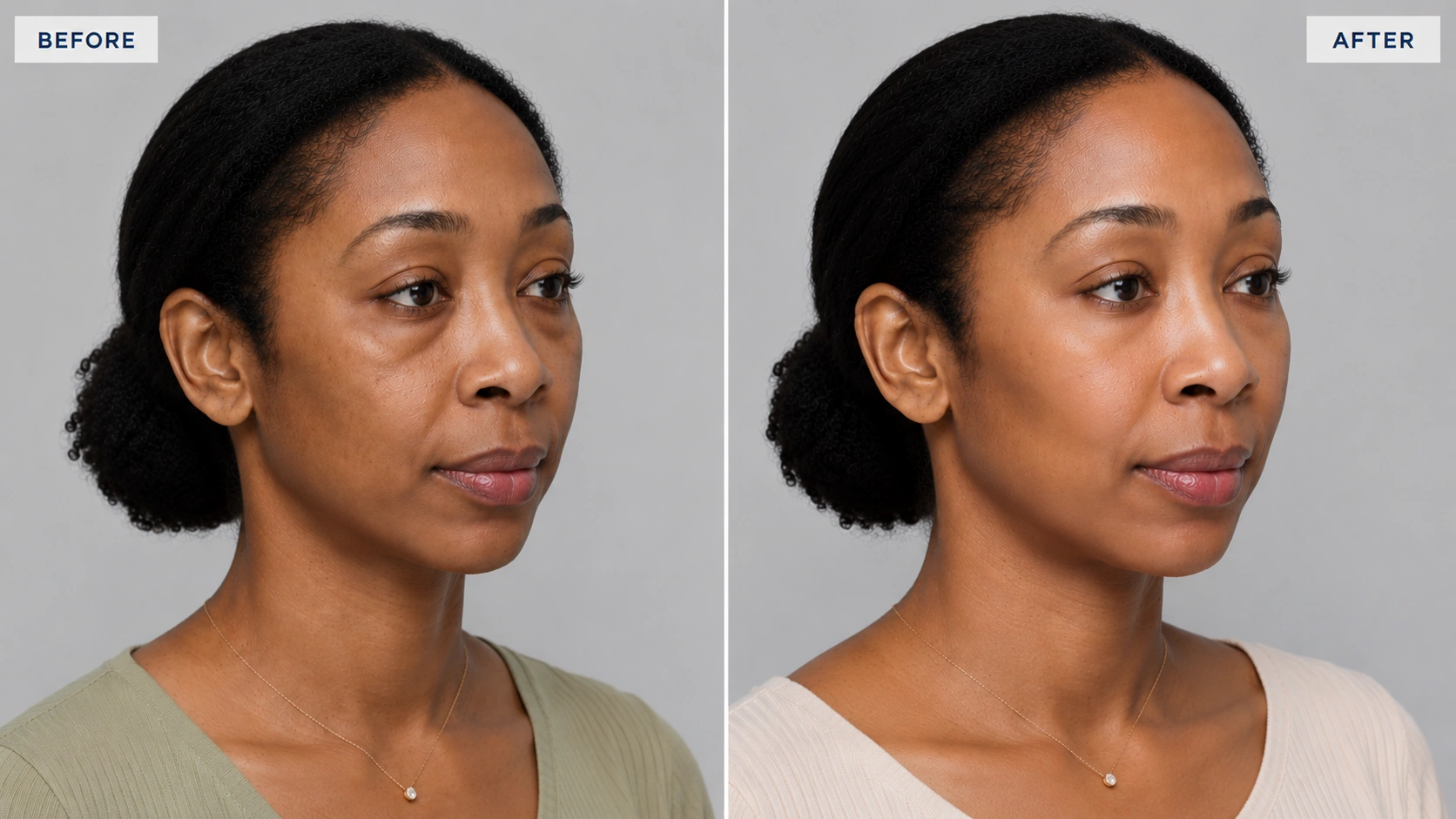 Before and after under-eye filler