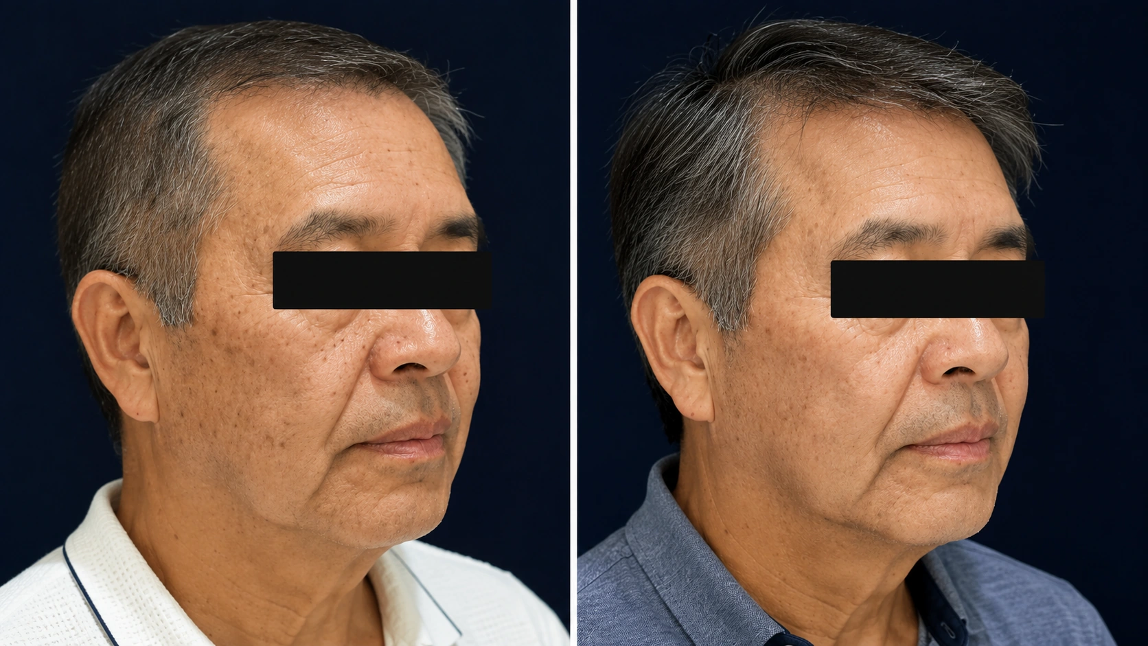 Sun damage and tone before and after pico laser sessions