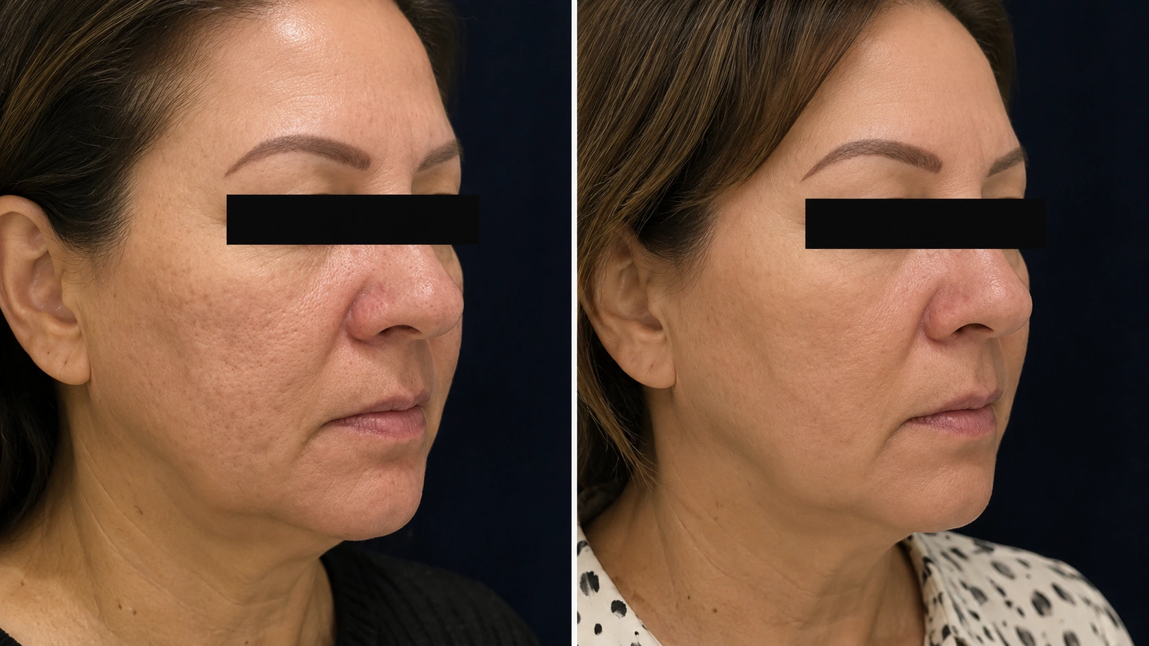 Skin tone and texture before and after pico laser rejuvenation