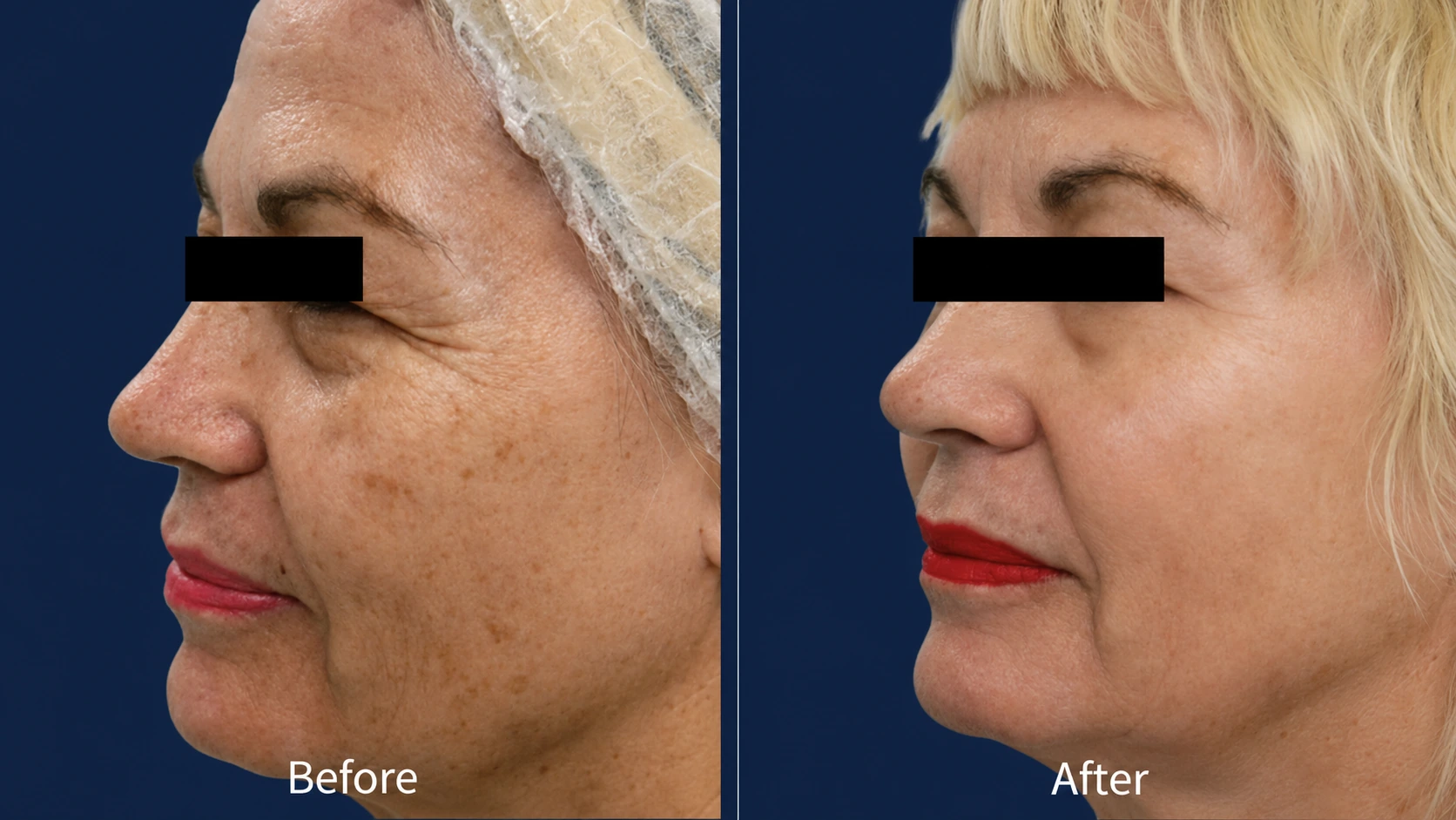 Even skin tone before and after pico laser rejuvenation