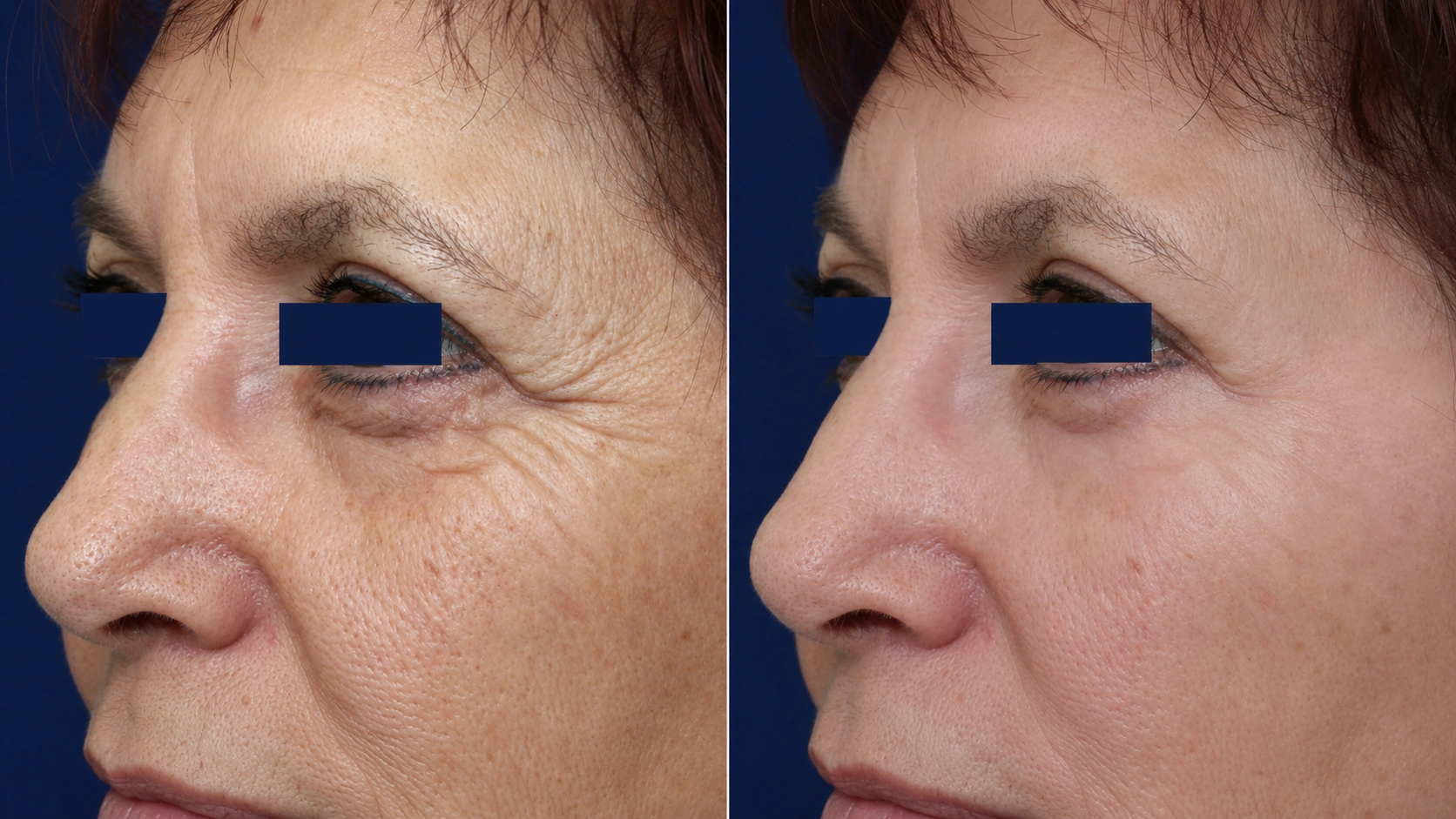 Skin rejuvenation before and after fractional CO2 laser resurfacing