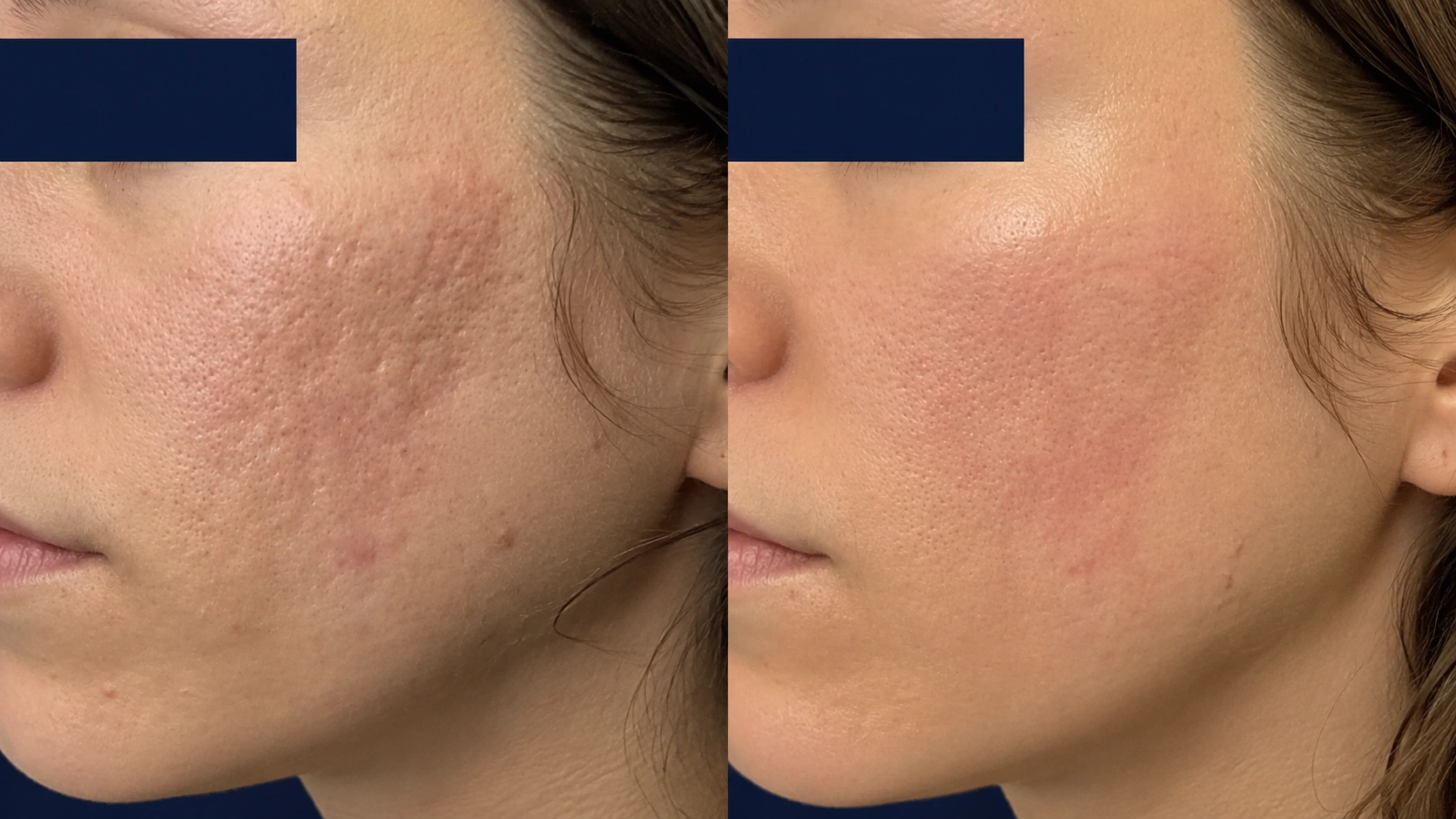 can i take glutathione push before fractional co2 laser Resurfacing Boston CO2 Fractional Resurfacing Laser |
