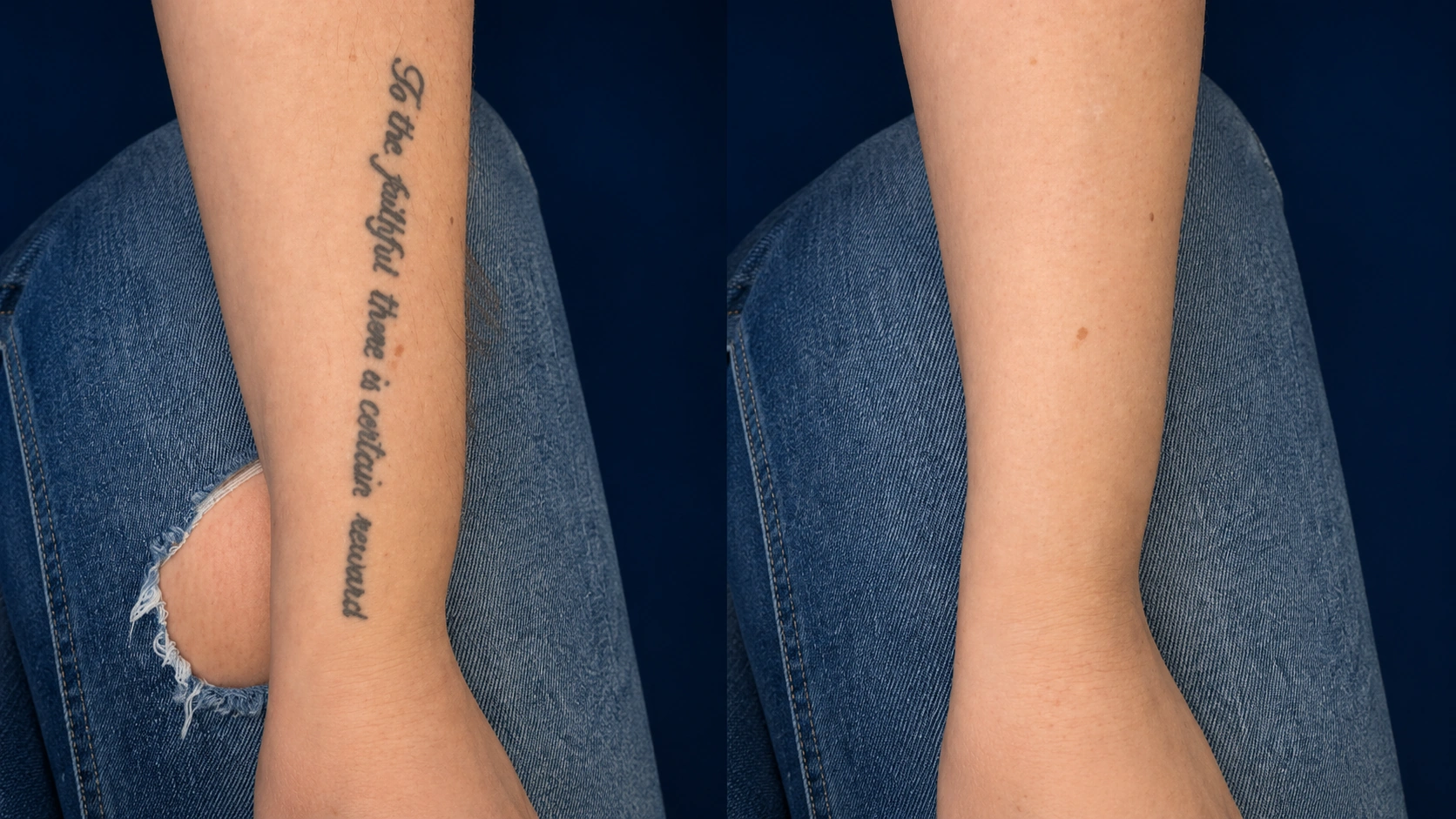 PicoSure tattoo removal before and after, forearm tattoo split view