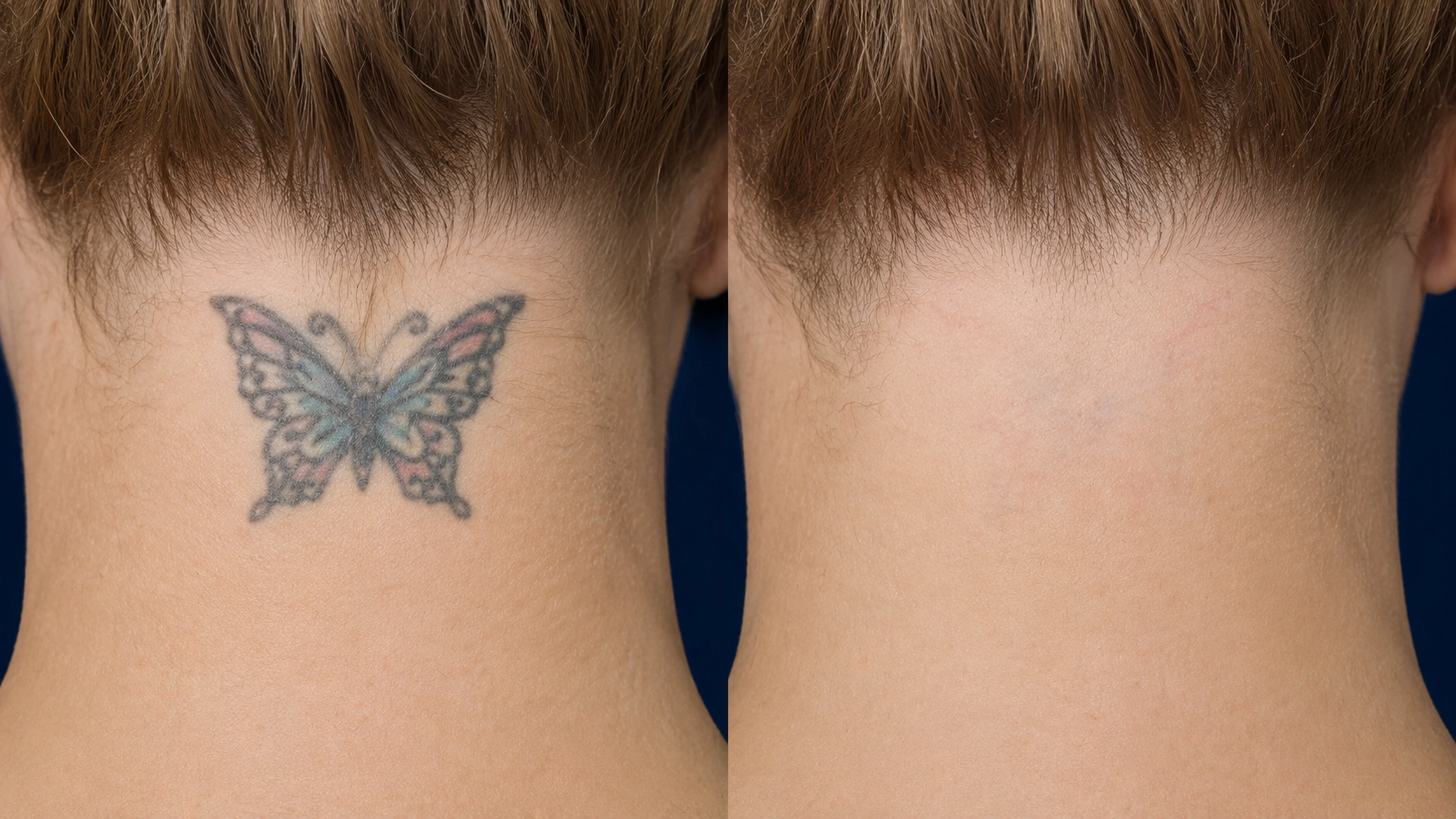 PicoSure tattoo removal before and after, neck tattoo fading progress