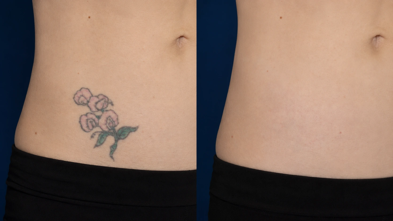 PicoSure tattoo removal before and after split view