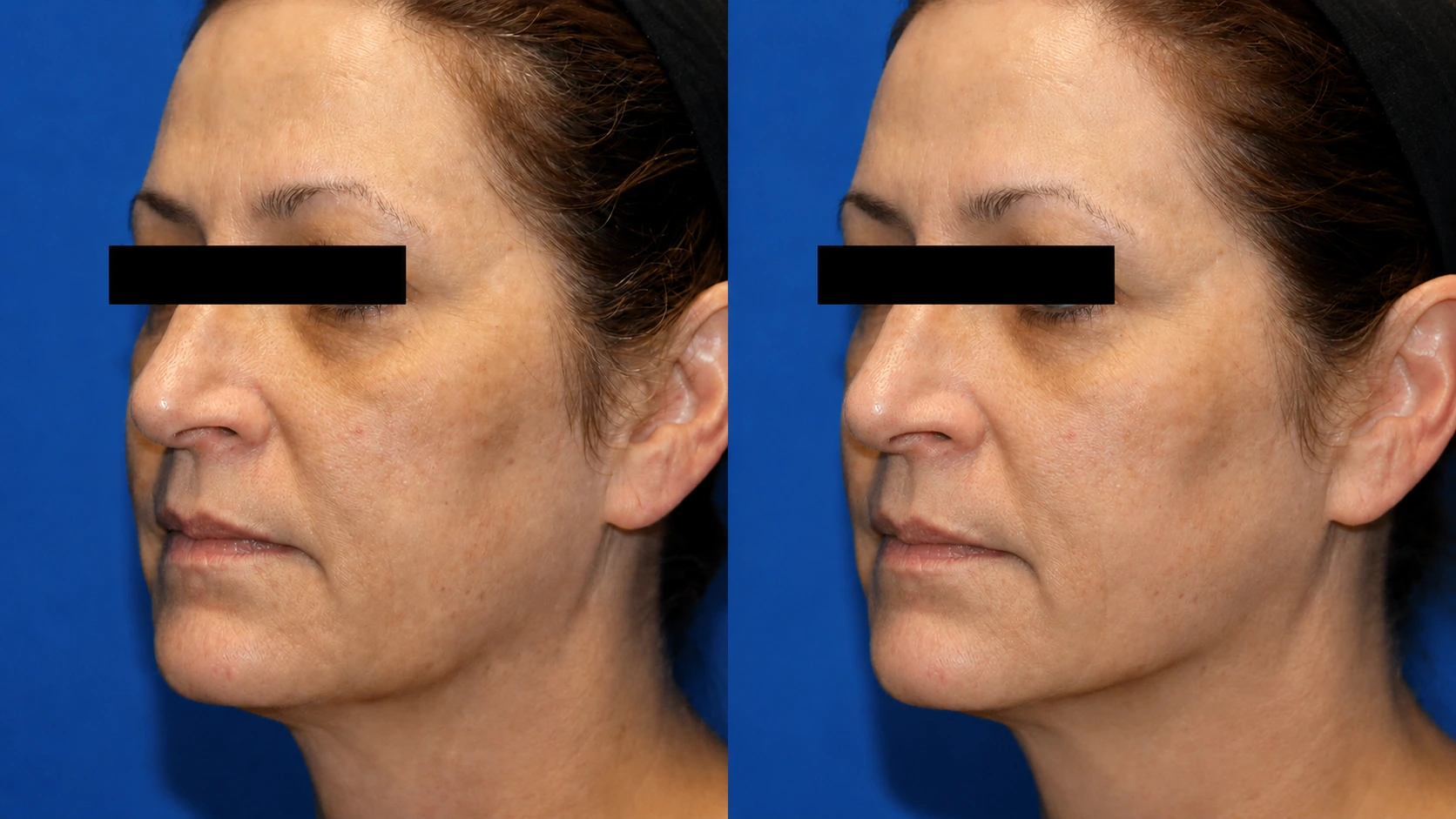 Before and after TempSure Envi treatment around the eyes