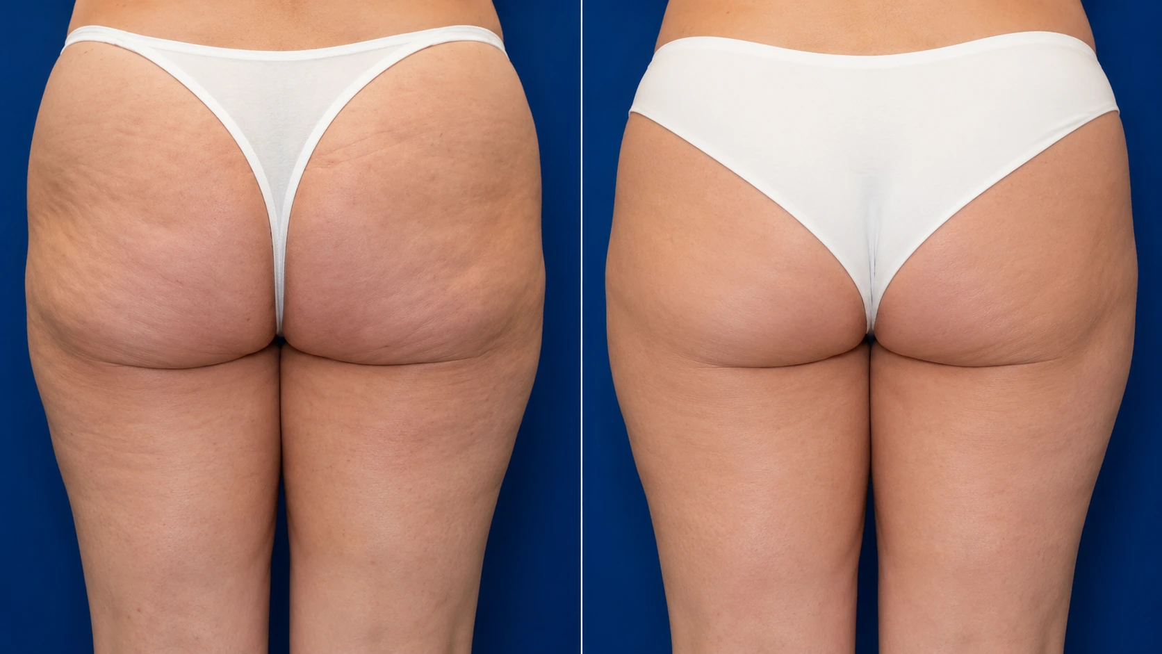 Before and after TempSure Envi body treatment